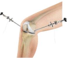 Knee Arthroscopy